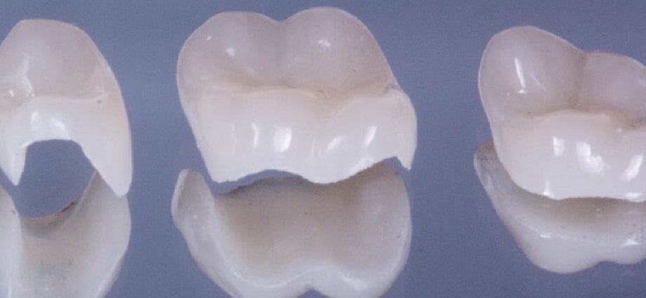 Керамическая пломба (керамическая вкладка – вкладка на зуб)